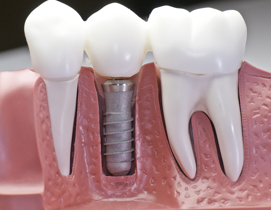 Dental Implants Dental Implants