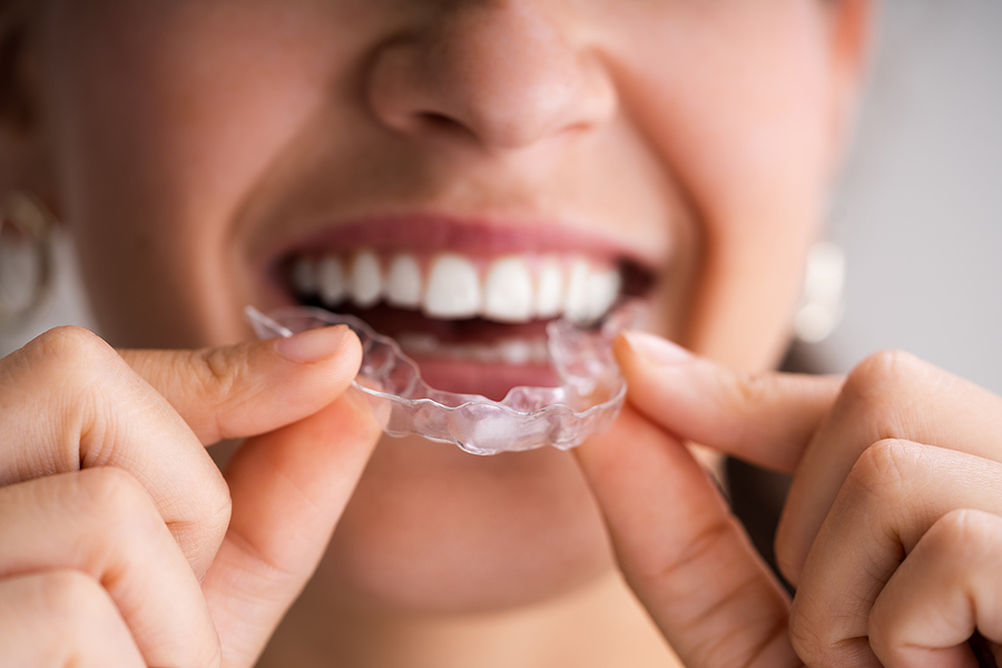 ClearCorrect Braces ClearCorrect Braces